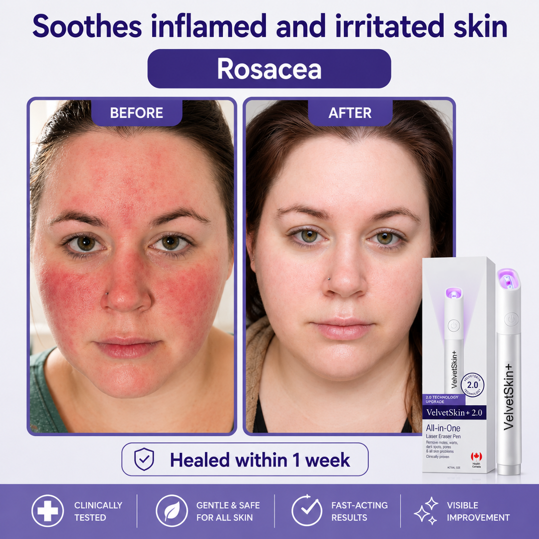 🔥 NEW 2026 GEN 2 Update☂FantasFeelets® VelvetSkin+ Photorejuvenation2.0 ⚔️All-in-One Laser Eraser Pen🖊️ (🔬Powered by Photorejuvenation – effectively removes moles, warts, skin tags, pigmentation spots, and other skin imperfections)