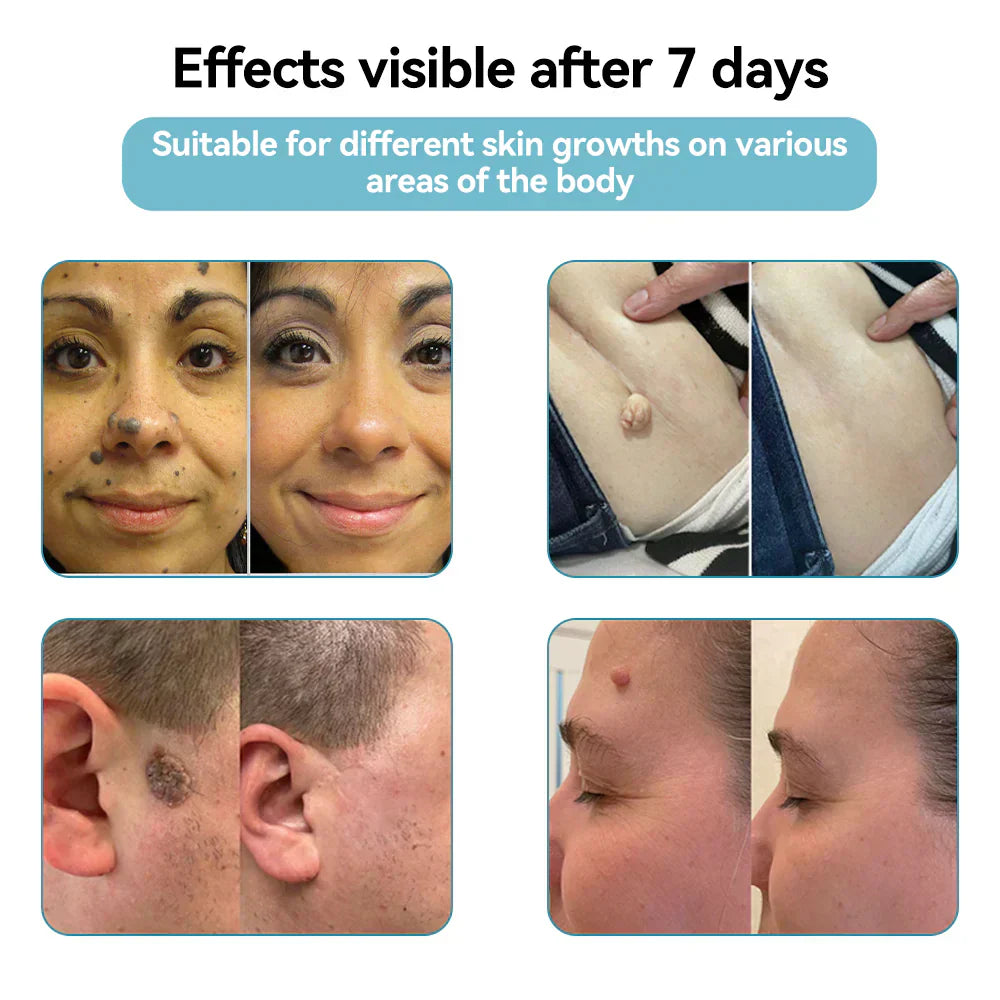 🔥 NEW 2026 GEN 2 Update☂Fantasfeelets® VelvetSkin+Series ⚔️All-in-One Laser Eraser Pen🖊️ (🔬Powered by CO₂ laser technology – effectively removes moles, warts, skin tags, pigmentation spots, and other skin imperfections)
