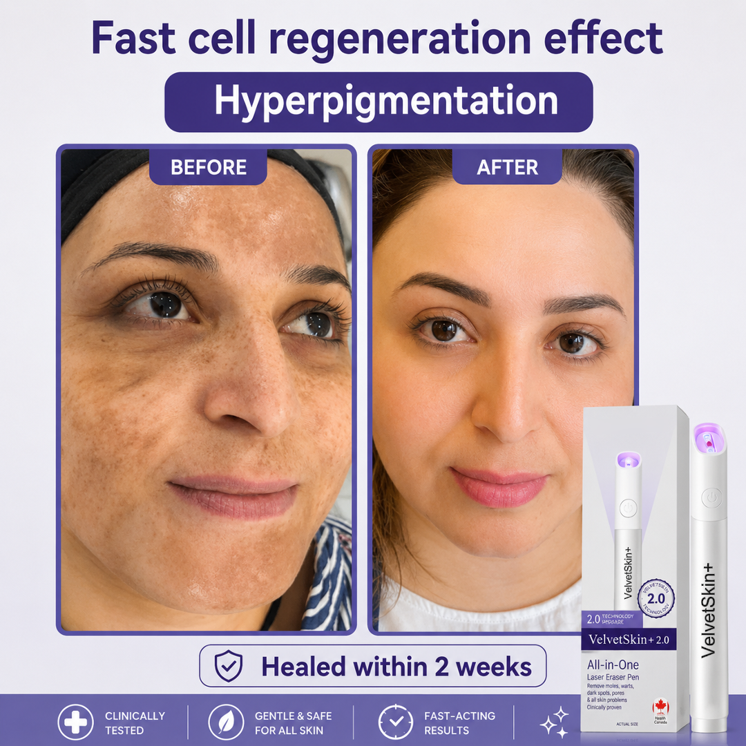 🔥 NEW 2026 GEN 2 Update☂FantasFeelets® VelvetSkin+ Photorejuvenation2.0 ⚔️All-in-One Laser Eraser Pen🖊️ (🔬Powered by Photorejuvenation – effectively removes moles, warts, skin tags, pigmentation spots, and other skin imperfections)