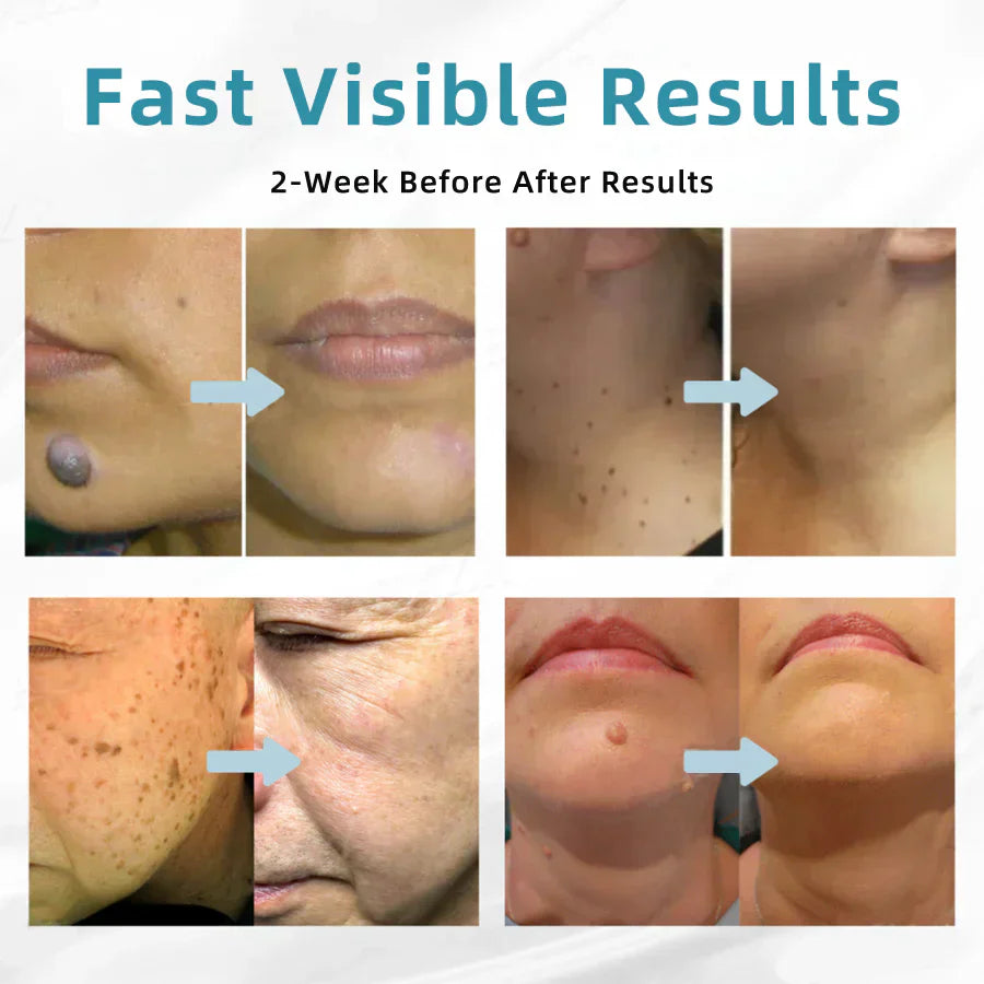 🔥 NEW 2026 GEN 2 Update☂Fantasfeelets® VelvetSkin+Series ⚔️All-in-One Laser Eraser Pen🖊️ (🔬Powered by CO₂ laser technology – effectively removes moles, warts, skin tags, pigmentation spots, and other skin imperfections)