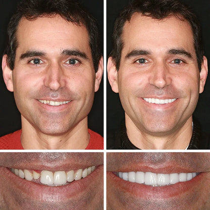 2026 NEW Upgraded 2.0🏆🌎Ends Today: 70% OFF! ⏰Fantasfeelets™ Medical Full Denture with Strong Suctiond🦷Obtain American Dental Association (ADA) Certification