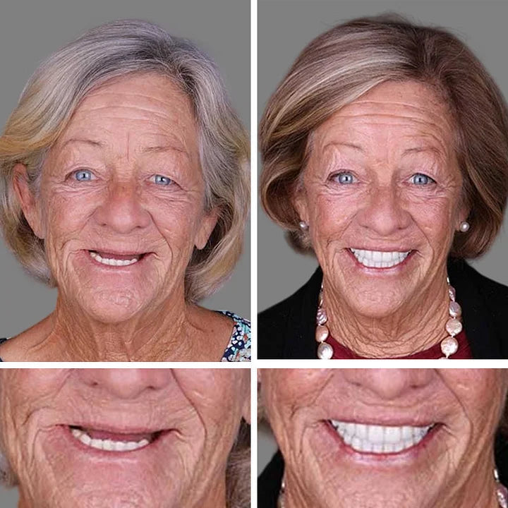 2026 NEW Upgraded 2.0🏆🌎Ends Today: 70% OFF! ⏰Fantasfeelets™ Medical Full Denture with Strong Suctiond🦷Obtain American Dental Association (ADA) Certification