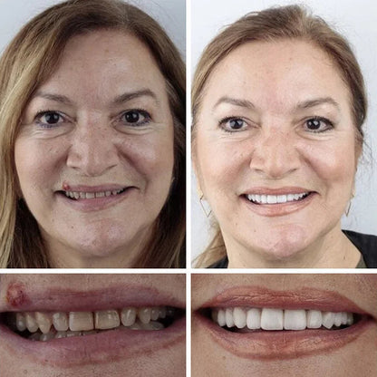 2026 NEW Upgraded 2.0🏆🌎Ends Today: 70% OFF! ⏰Fantasfeelets™ Medical Full Denture with Strong Suctiond🦷Obtain American Dental Association (ADA) Certification