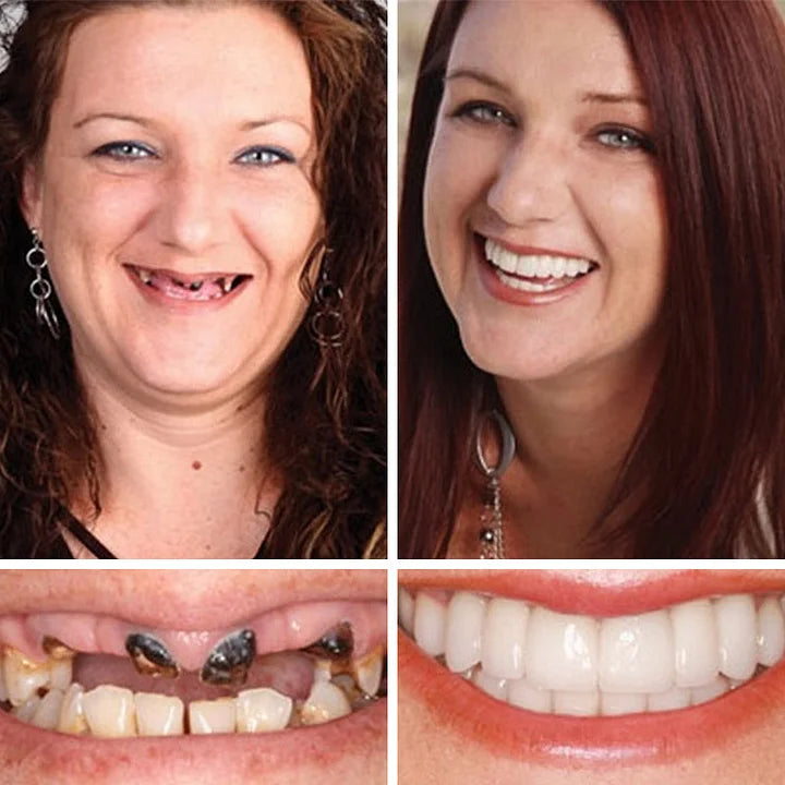 2026 NEW Upgraded 2.0🏆🌎Ends Today: 70% OFF! ⏰Fantasfeelets™ Medical Full Denture with Strong Suctiond🦷Obtain American Dental Association (ADA) Certification