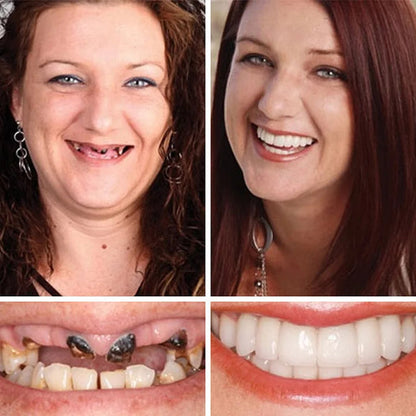 2026 NEW Upgraded 2.0🏆🌎Ends Today: 70% OFF! ⏰Fantasfeelets™ Medical Full Denture with Strong Suctiond🦷Obtain American Dental Association (ADA) Certification