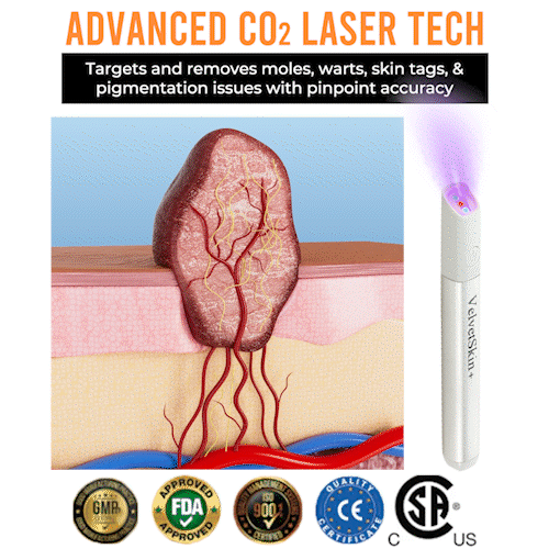 🔥 NEW 2026 GEN 2 Update☂Fantasfeelets® VelvetSkin+Series ⚔️All-in-One Laser Eraser Pen🖊️ (🔬Powered by CO₂ laser technology – effectively removes moles, warts, skin tags, pigmentation spots, and other skin imperfections)