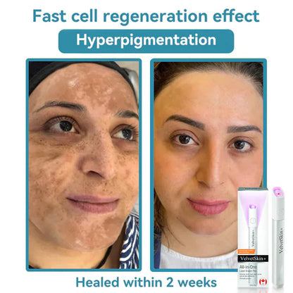 🔥 NEW 2026 GEN 2 Update☂Fantasfeelets® VelvetSkin+Series ⚔️All-in-One Laser Eraser Pen🖊️ (🔬Powered by CO₂ laser technology – effectively removes moles, warts, skin tags, pigmentation spots, and other skin imperfections)