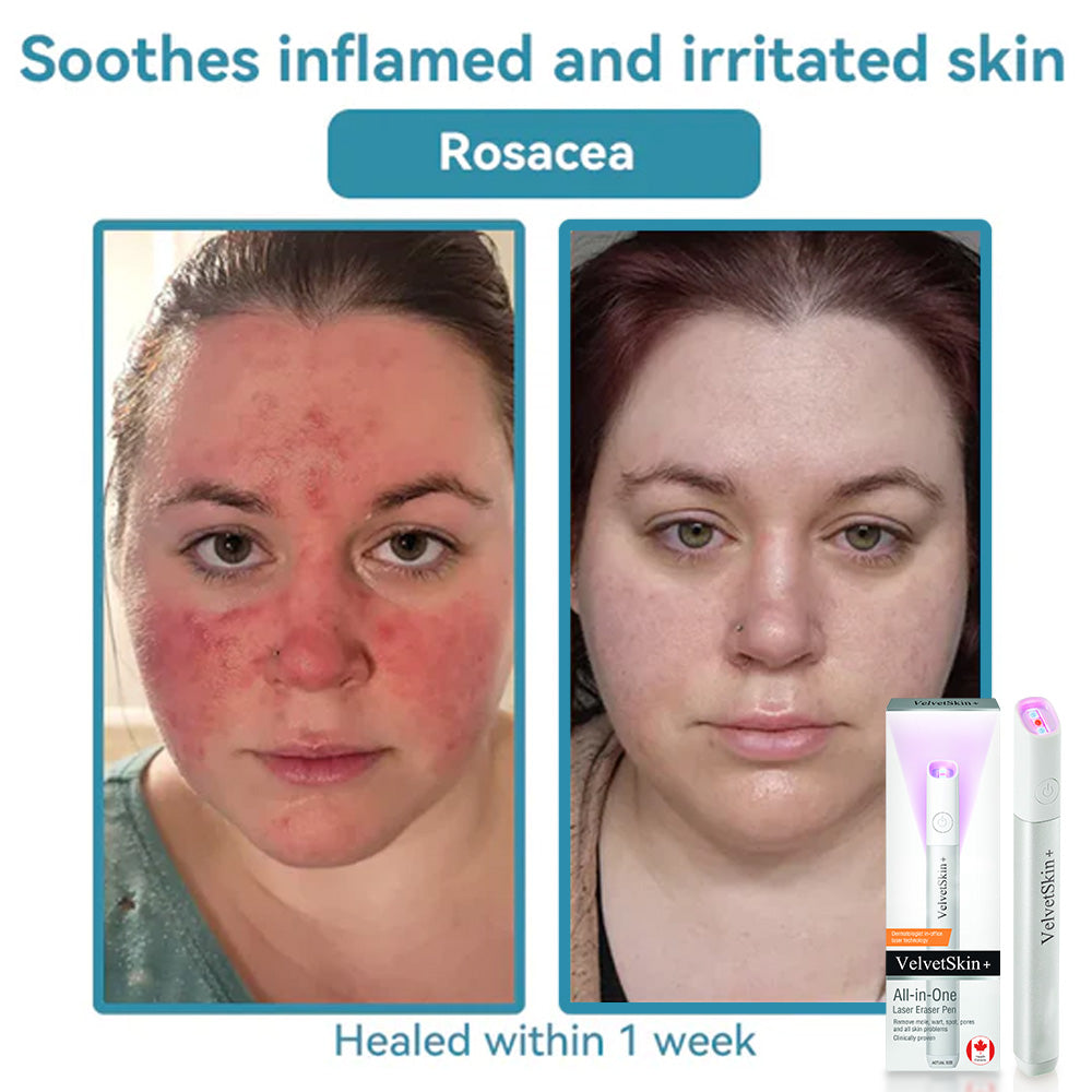 🔥 NEW 2026 GEN 2 Update☂Fantasfeelets® VelvetSkin+Series ⚔️All-in-One Laser Eraser Pen🖊️ (🔬Powered by CO₂ laser technology – effectively removes moles, warts, skin tags, pigmentation spots, and other skin imperfections)