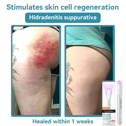 🔥 NEW 2026 GEN 2 Update☂Fantasfeelets® VelvetSkin+Series ⚔️All-in-One Laser Eraser Pen🖊️ (🔬Powered by CO₂ laser technology – effectively removes moles, warts, skin tags, pigmentation spots, and other skin imperfections)